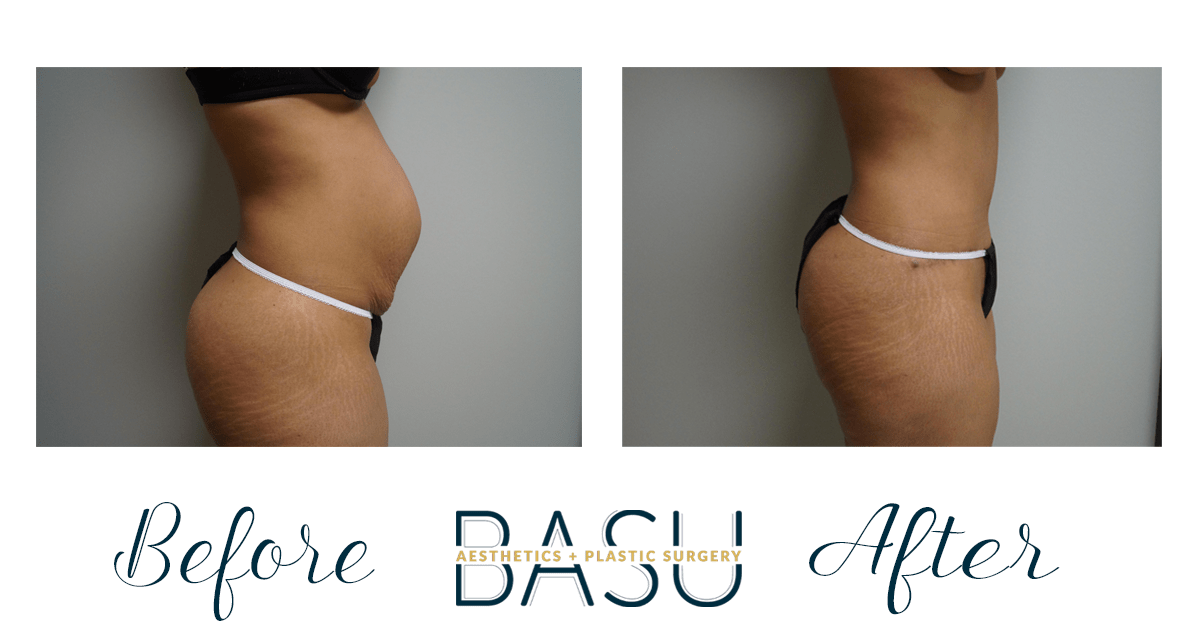 Your Guide to a Post-Pregnancy Tummy Tuck - Basu Aesthetics