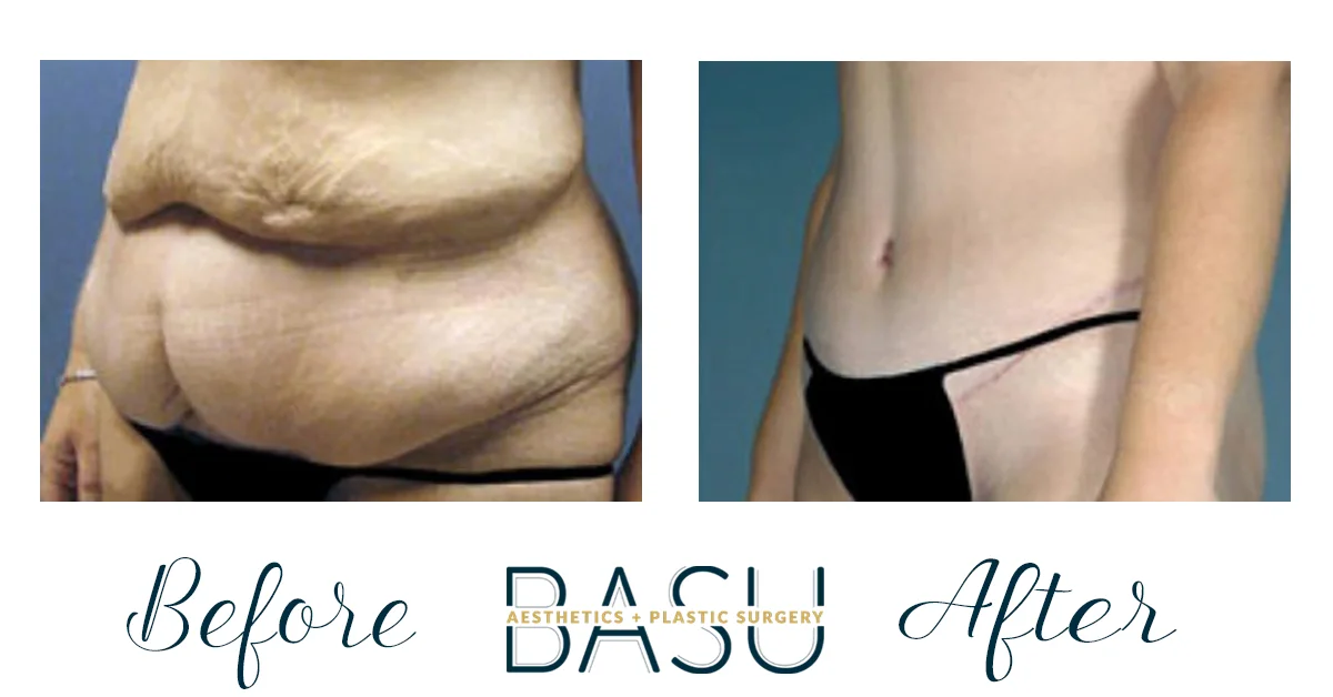 Sleek & Strong: The Surprise Benefits of a Tummy Tuck - Armijo