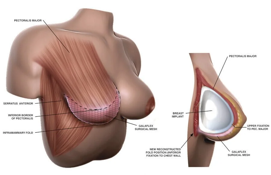 Recovery Bra  Breast Implants - Reduction Mammoplasty