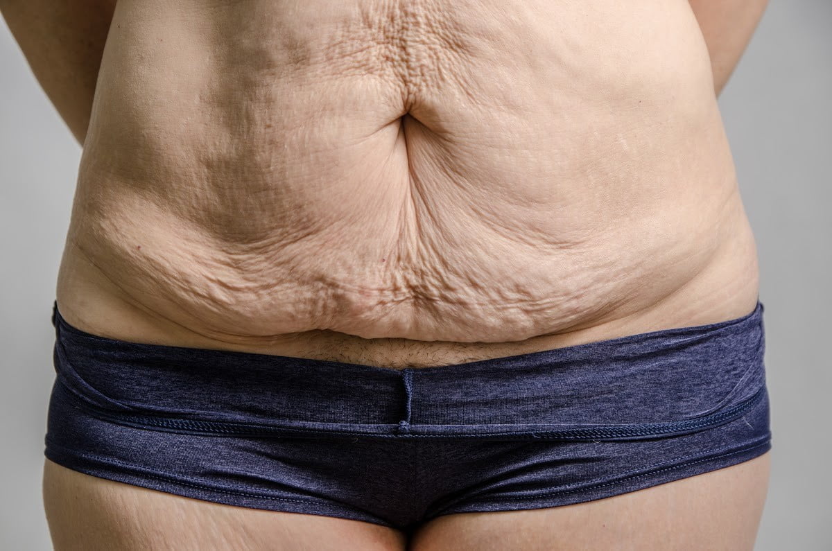 FAQs About Post-Bariatric Body Contouring