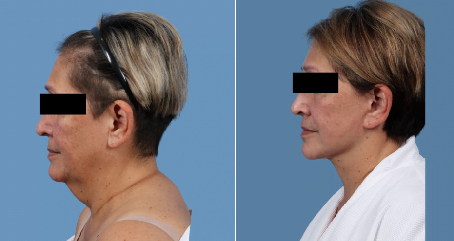 Real patient before and after face and neck lift with Houston plastic surgeon Dr. Bob Basu