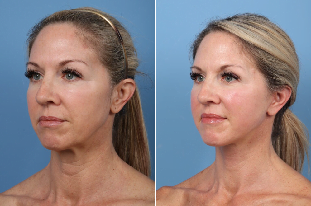 Real patient before and after face and neck lift with Houston plastic surgeon Dr. Bob Basu