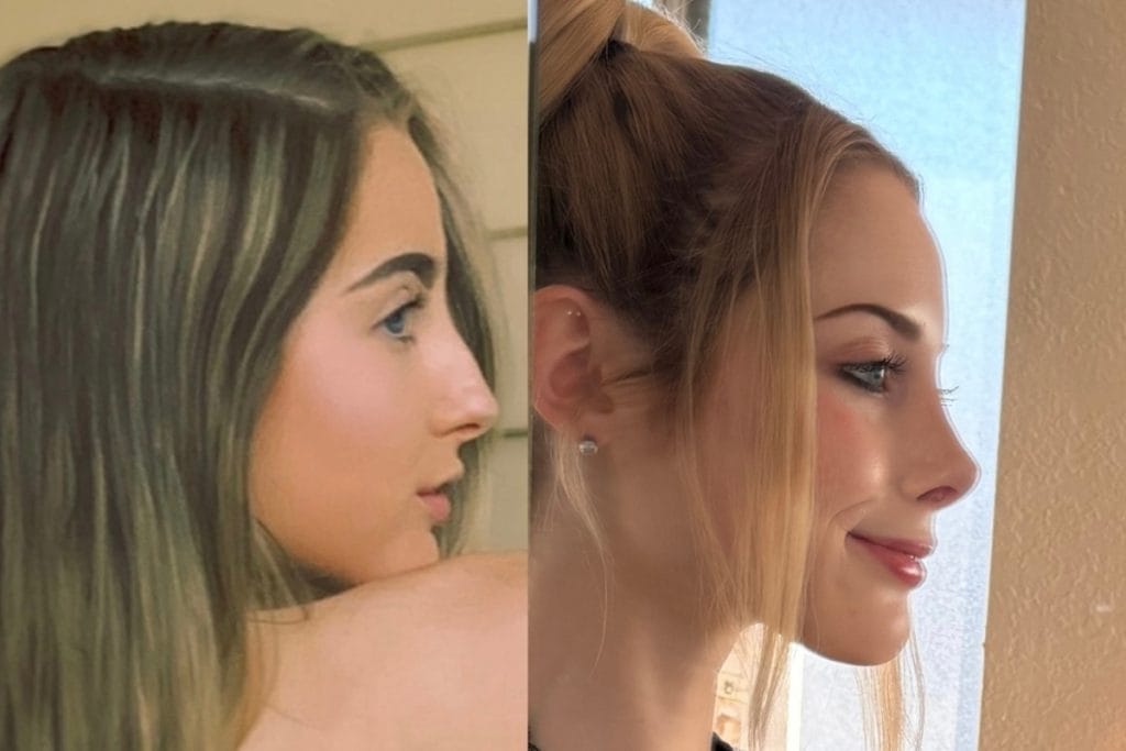 Dr. DeBusk's patient Hannah one year after her rhinoplasty